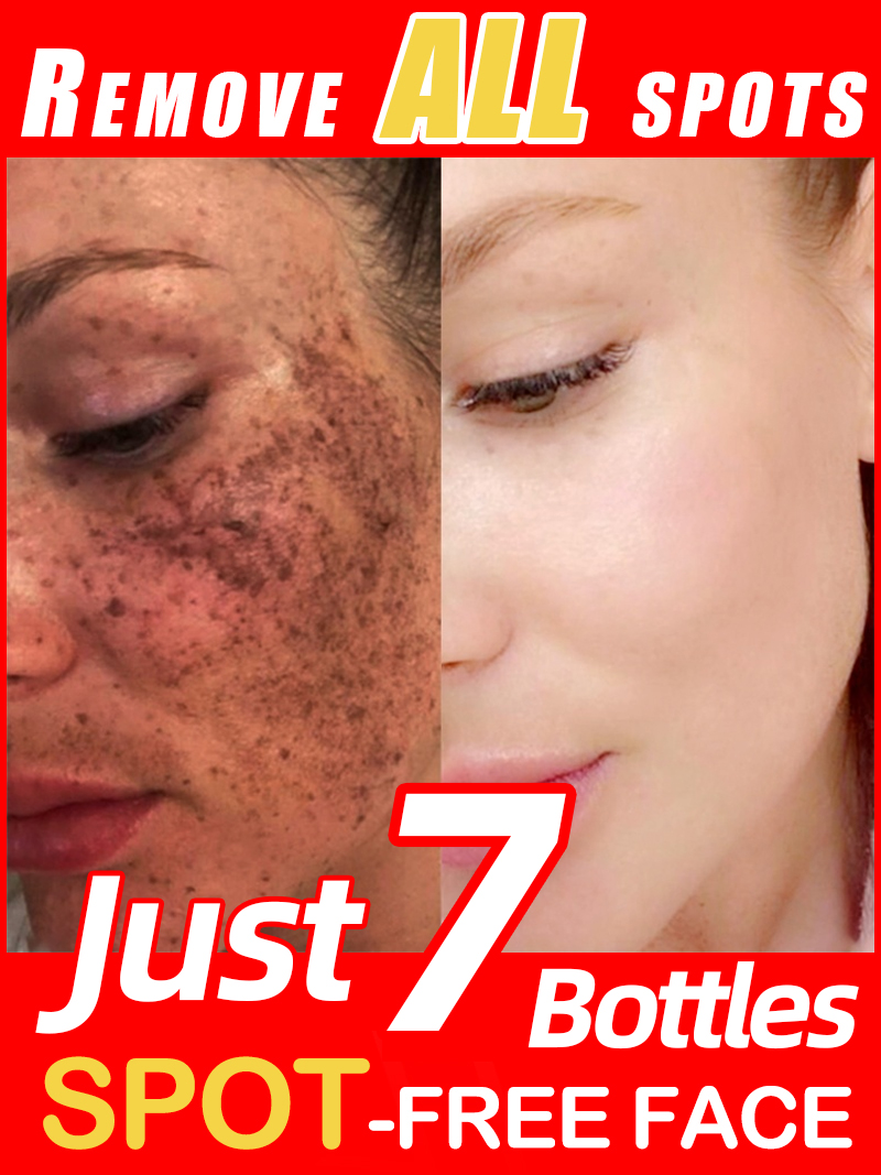 Lighten Freckles Melasma, Faci - Luxury Skincare Essence review and price