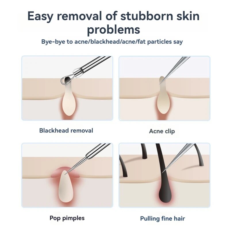7pcs Stainless Steel Splinter  - Luxury Skincare Acne review and price